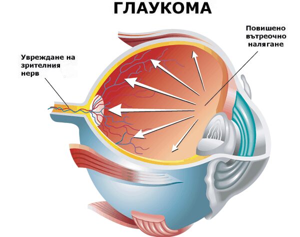 Глаукома